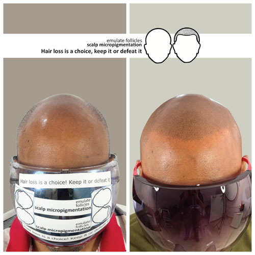 arnab before and after scalp micropigmentation