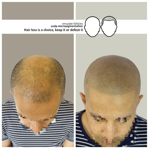 kaif before and after scalp micropigmentation