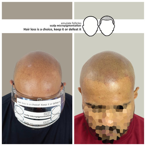 roshan before and after scalp micropigmentation