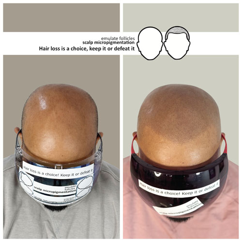 satish before and after scalp micropigmentation