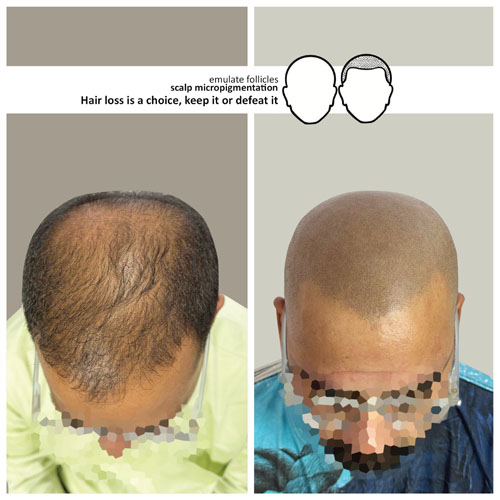 sunny before and after scalp micropigmentation