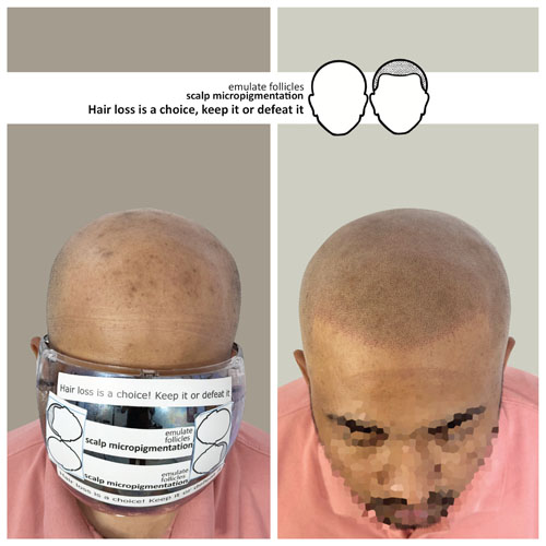 yousuf before and after scalp micropigmentation