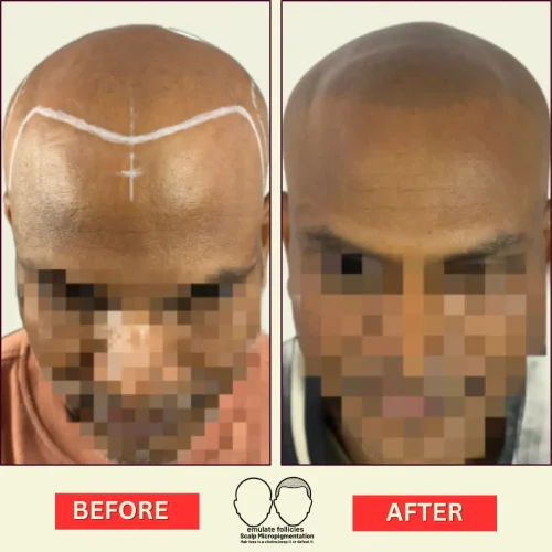 sunil-scalp-micropigmentation-before-and-after-result